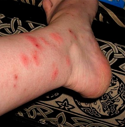 следы укусов клопов на ногах человека