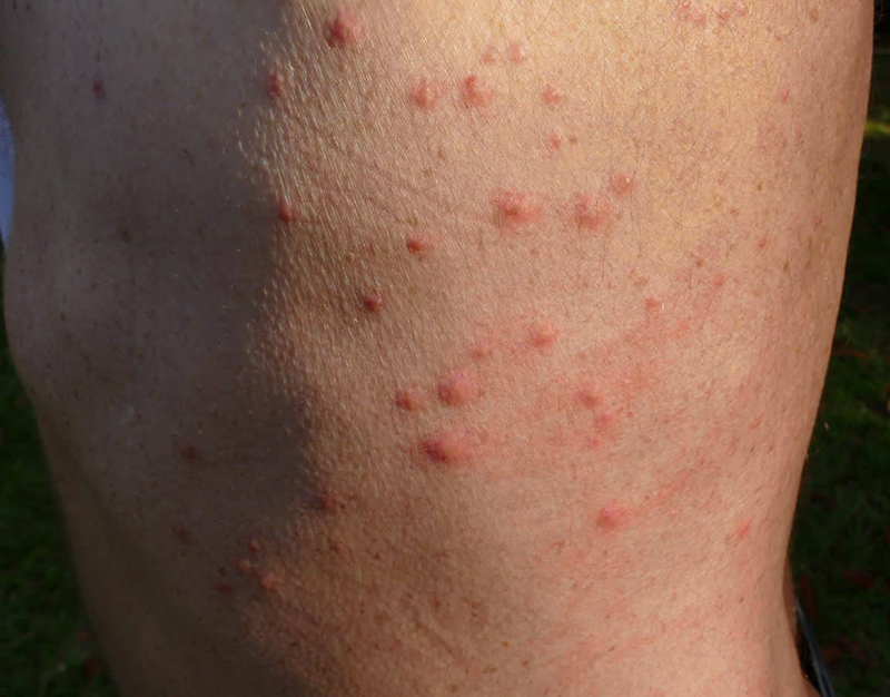 Какие следы остаются от постельных клопов на теле после укусов и чем они отличаются от укуса комаров?