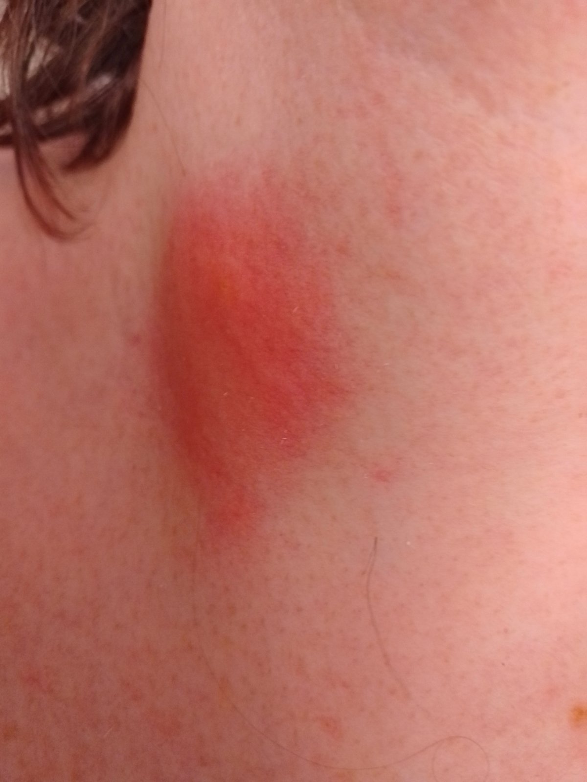 начало аллергической реакции после укуса осы в шею в Москве