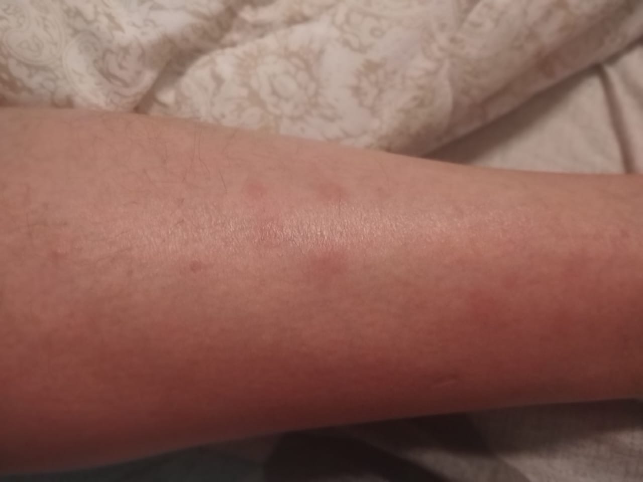 Как клопы могут нарушить психику: синдром фантомных укусов