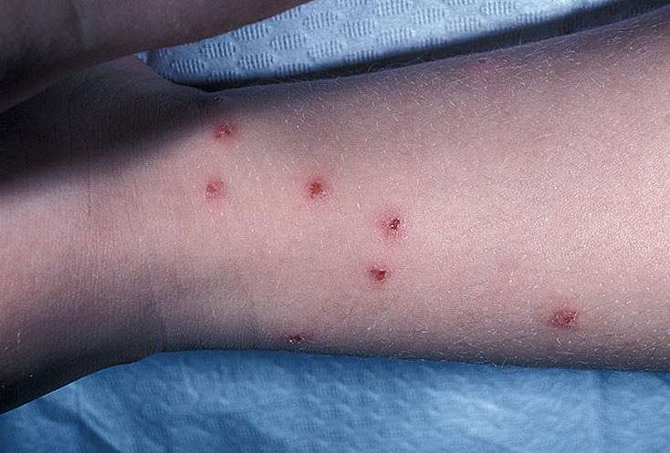 Зажившие раны после укусов комаров у человека в Москве